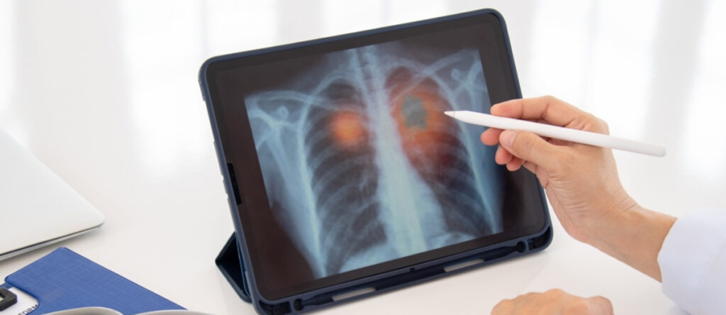 tumore polmoni santagostino cernusco