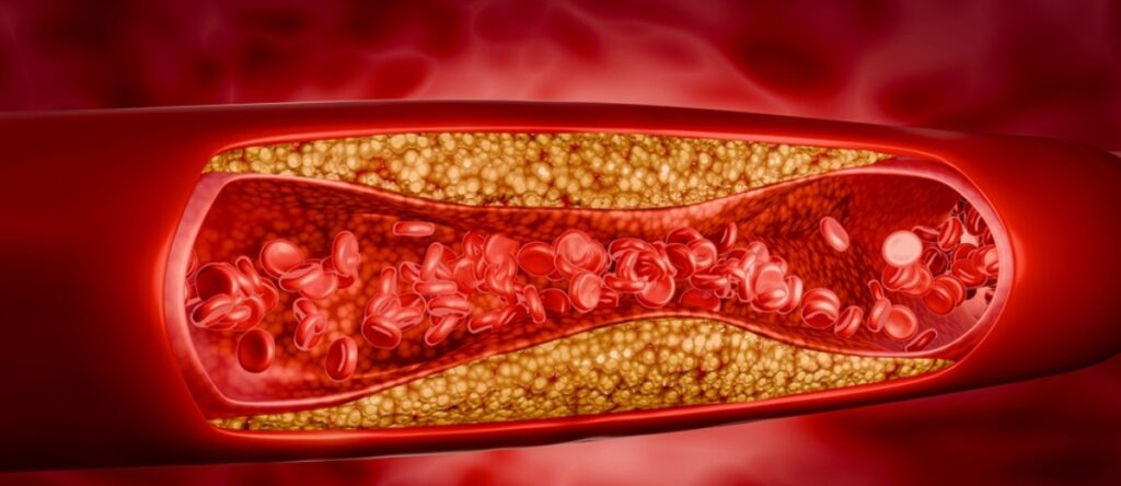 aterosclerosi cernusco