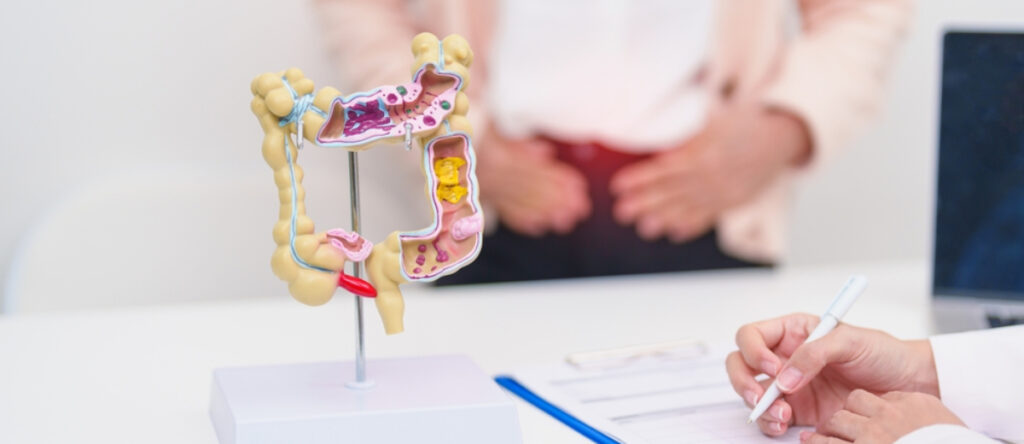 diverticolite cernusco