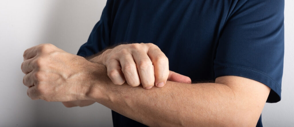 herpes zoster cernusco