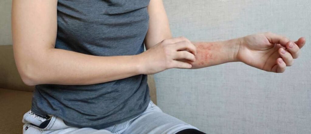 psoriasi cernusco