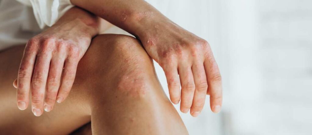 psoriasi cernusco