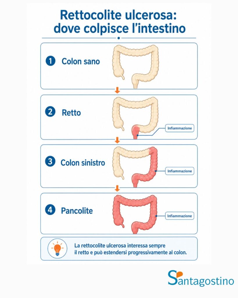 dove colpisce la rettocolite ulcerosa