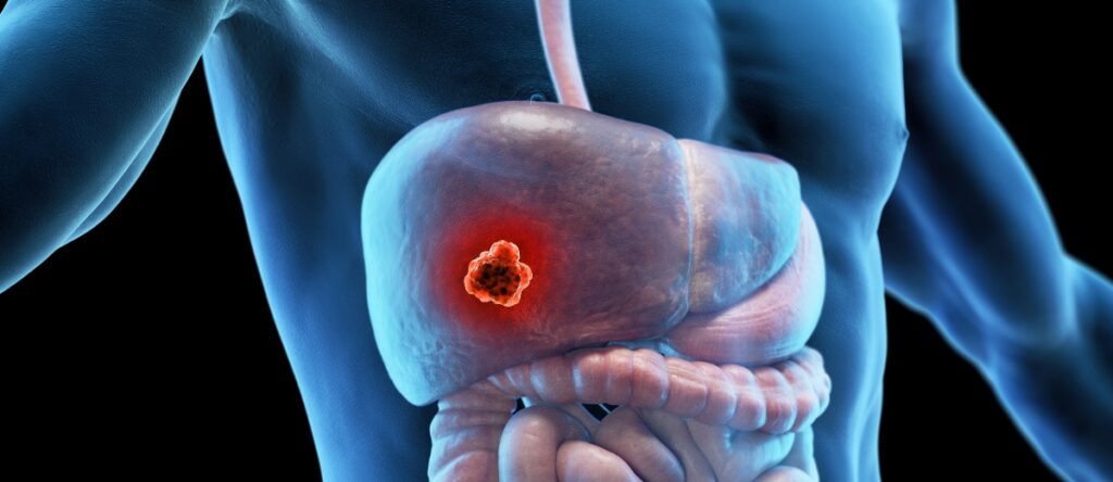 colangiocarcinoma santagostino cernusco