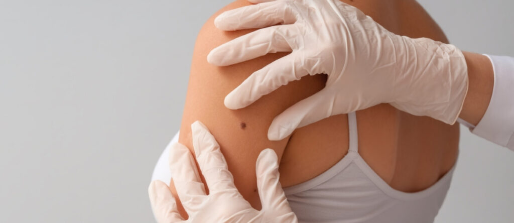 melanoma cernusco