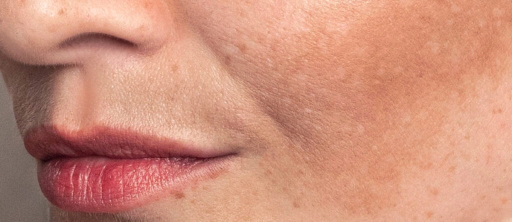 melasma cernusco