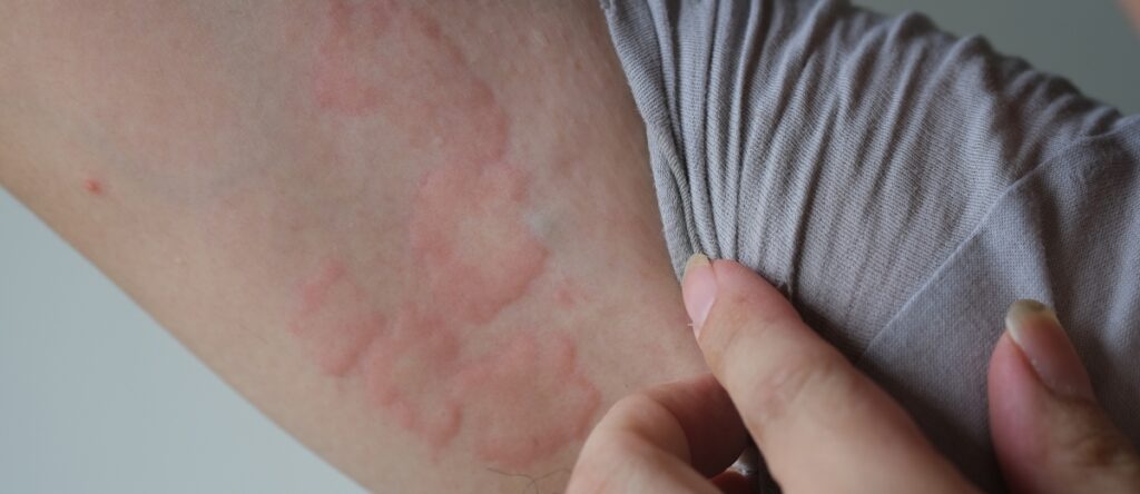 orticaria santagostino cernusco
